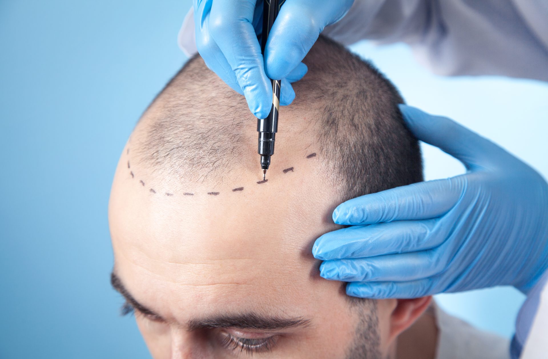 man with hair loss getting hair transplant consultation