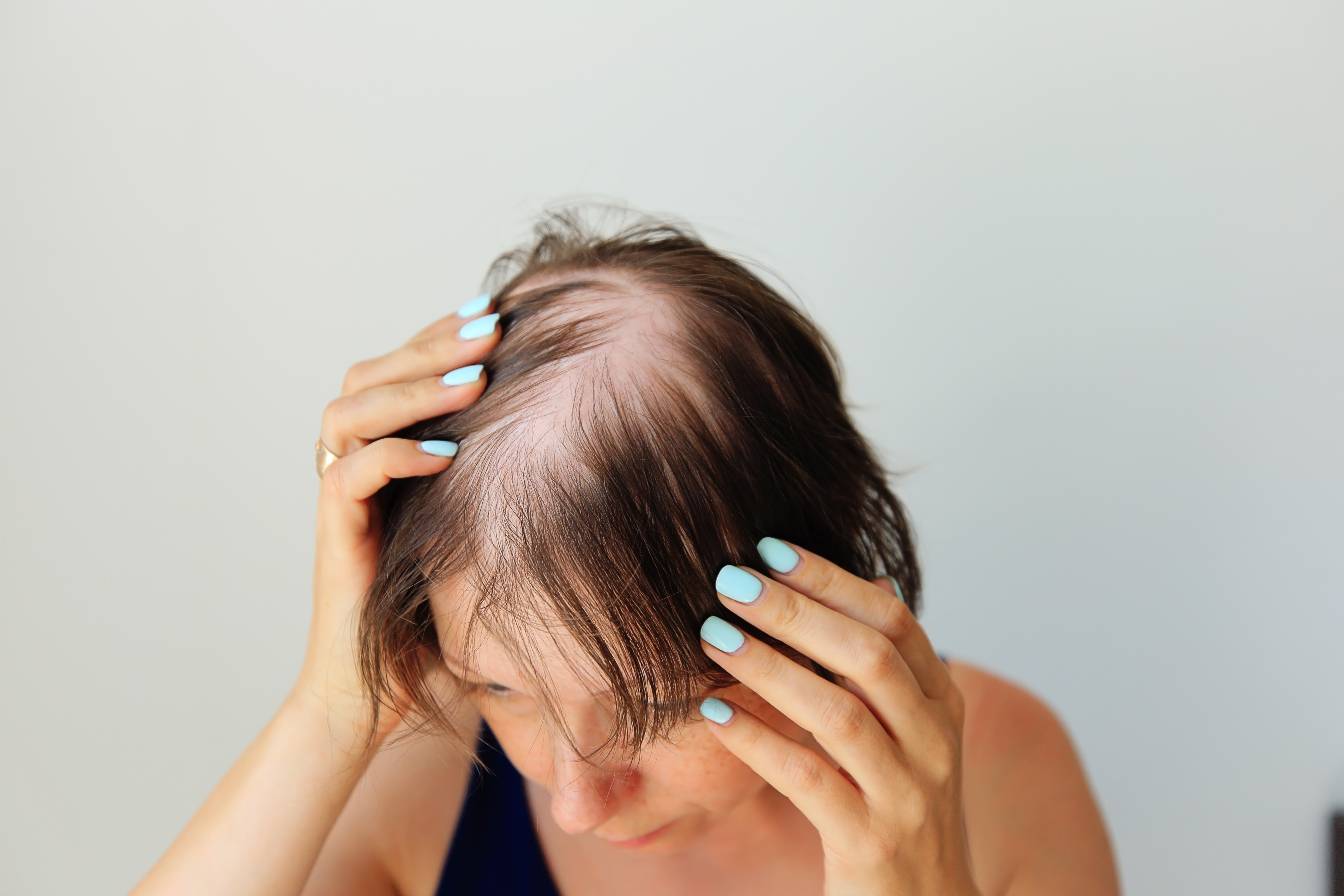 a woman holding her head due to hair loss in the mirror. she is learning that her hair loss is affected by hormonal issues.